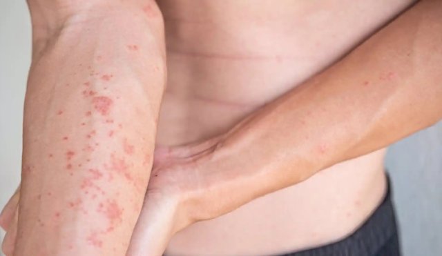 dermatitis atópica